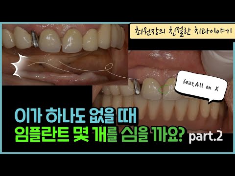 올온4 아래턱 뼈가 부족한경우 뼈이식없이 임플란트를 수복하는 방법