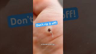 Don't Rip Off That Bump