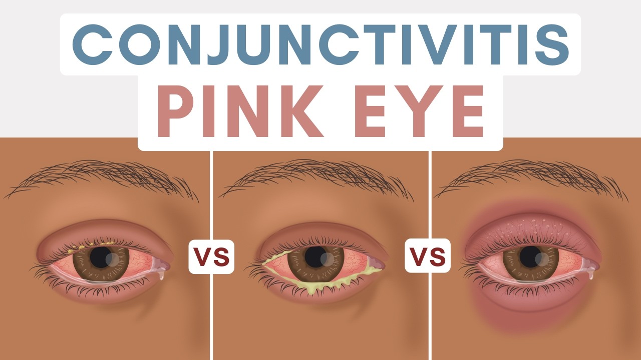 Конъюнктивит (упрощенно): вирусный, бактериальный и аллергический