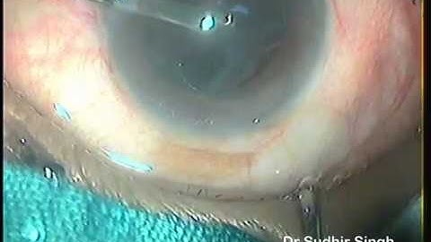 irrigation Aspiration by Simcoe Cannula Through  Side Ports