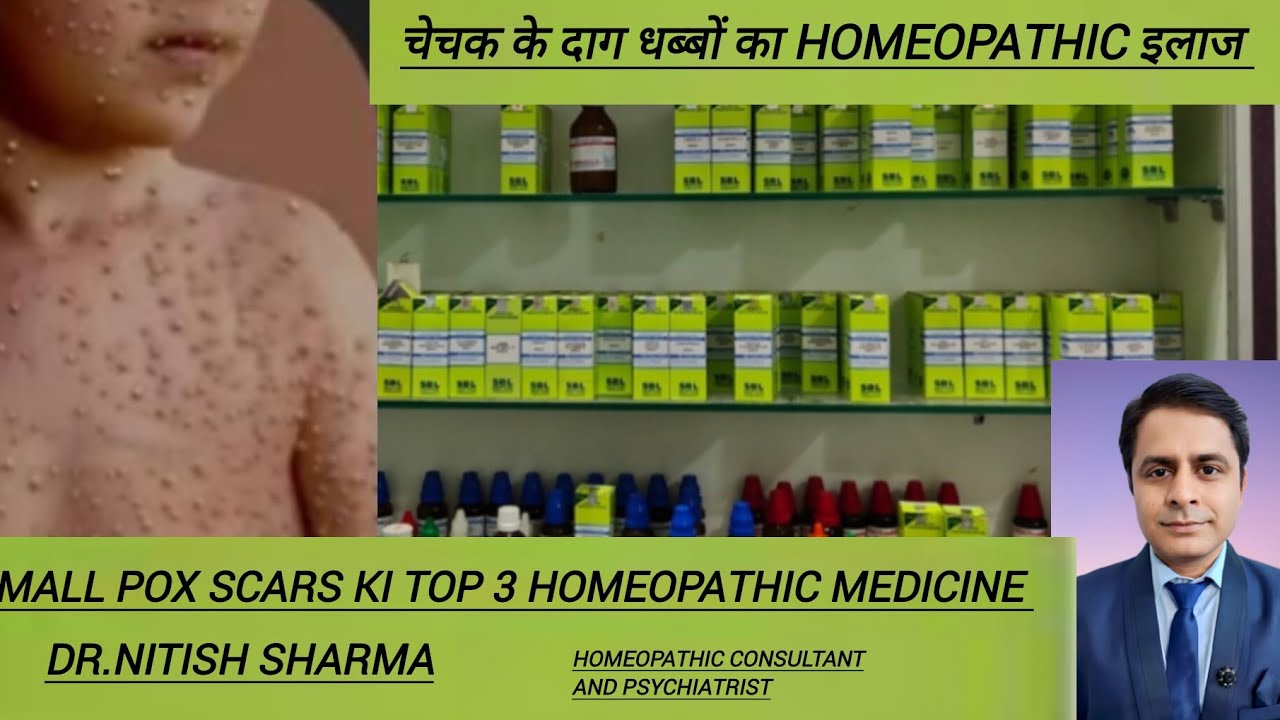 Best 3 homeopathic medicine for chicken pox scars / chicken pox ke daag dhabbon ka homeopathic ilaz