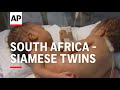South Africa - Siamese twins