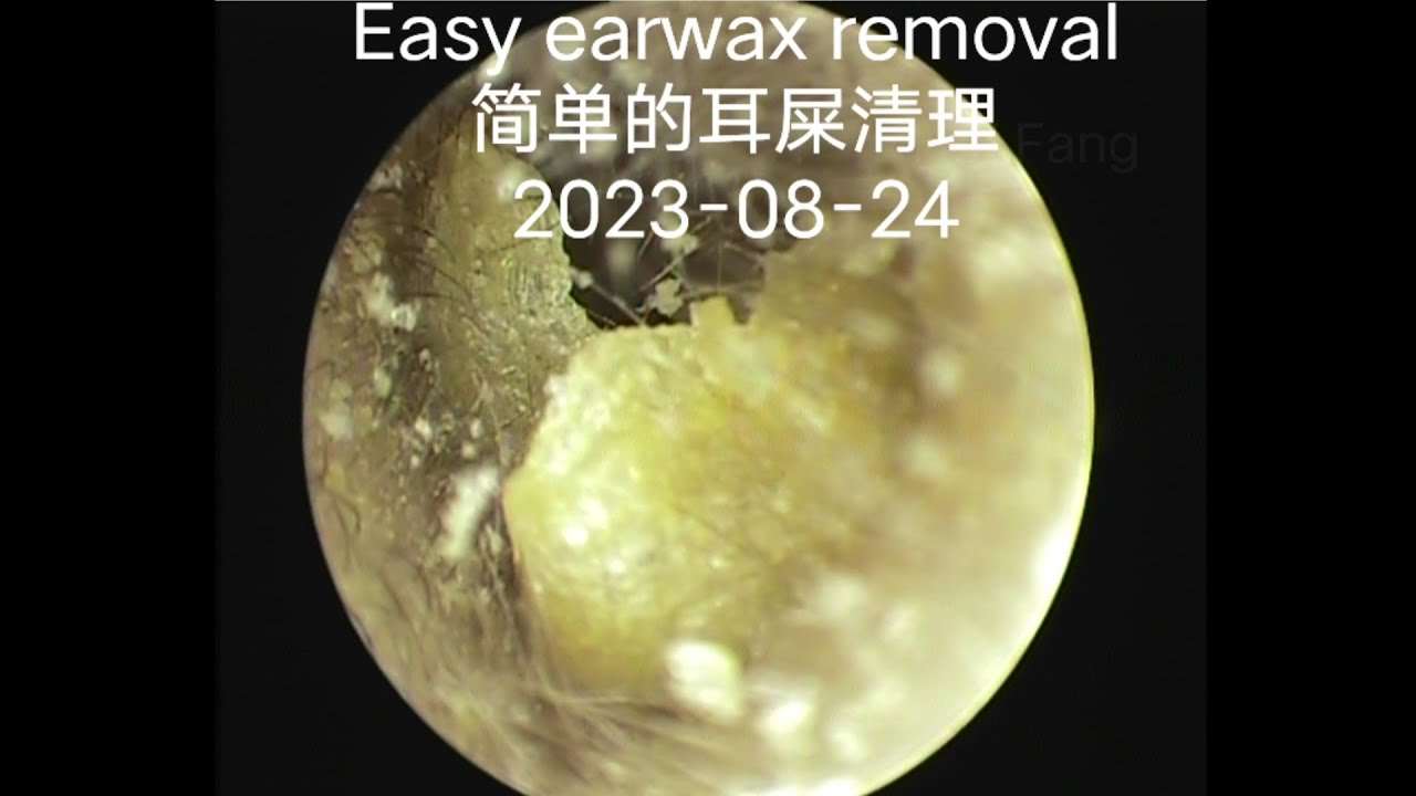 Easy earwax removal简单的耳屎清理20230824 YouTube
