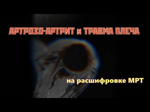 Признаки ТРАВМЫ плеча,