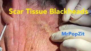 Embedded scar tissue blackhead extractions. Deep squeeze. MrPopZit