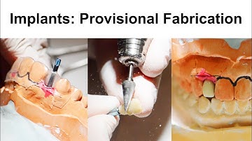 5. Implants: Provisional Fabrication