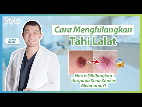 Video: Adakah semua tahi lalat berbentuk barah?