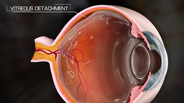 Posterior Vitreous Detachment - PVD