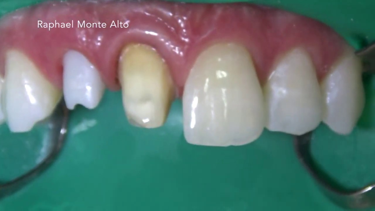 Cimentação de coroas totais