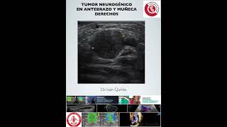 Tumor Neurogénico Antebrazo Y Muñeca Derechos. Evolución Lenta Asintomático