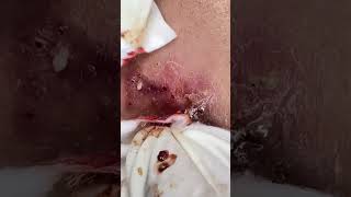 Big Cystic Acne Blackheads Extraction Blackheads & Milia, Whiteheads Removal Pimple Popping shorts