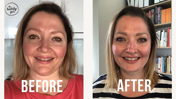 14 Days on The Elemental Diet for SIBO: Before and...