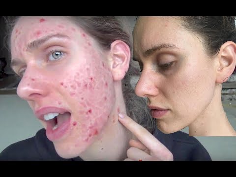 HOW GOING VEGAN HELPED CLEAR MY ACNE