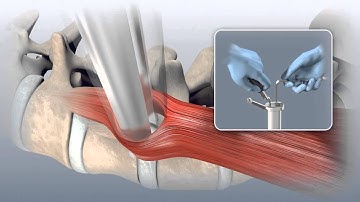 ChoiceSpine VEO® Lateral Access & Interbody Fusion System