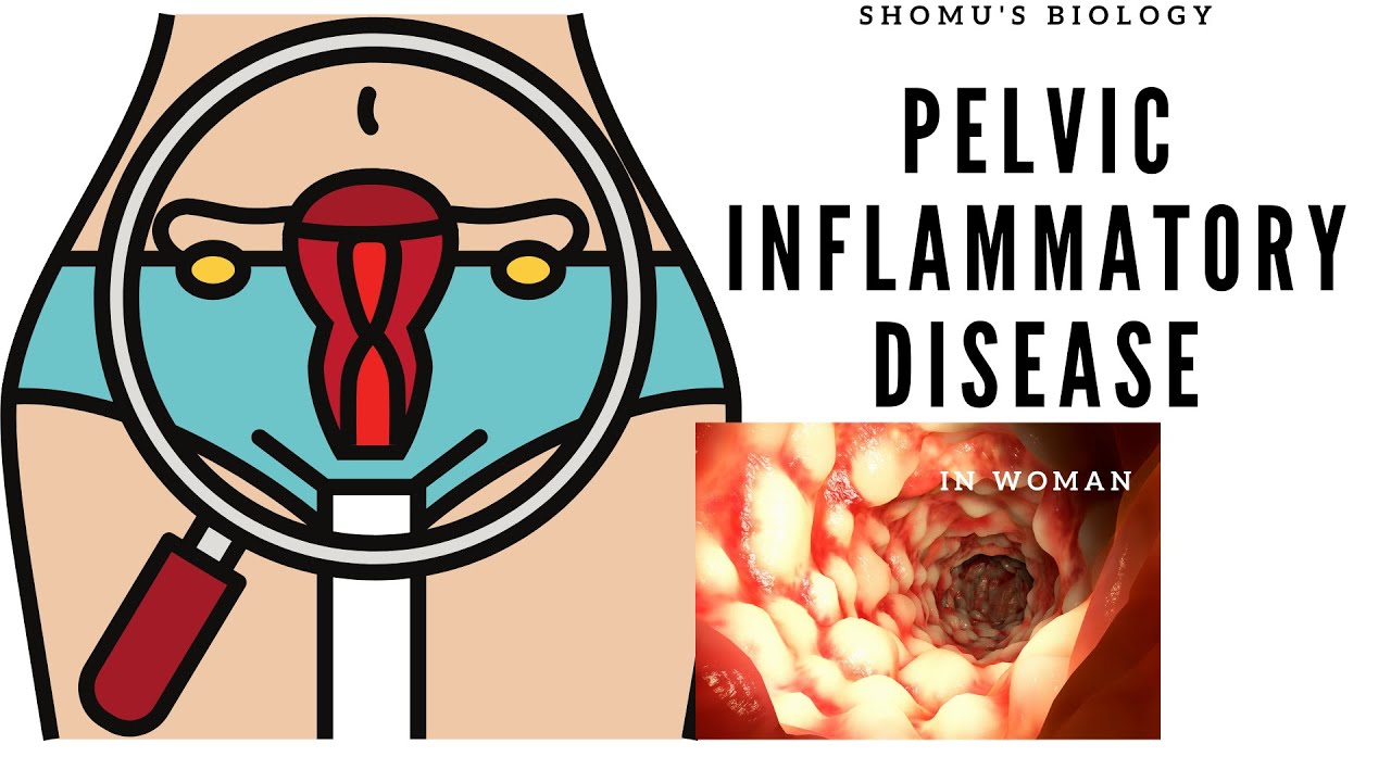 Pelvic inflammatory disease in Hindi Symptoms, treatment in females