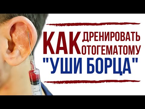 Видео: Гематома уха Карман в ухе, наполненный кровью