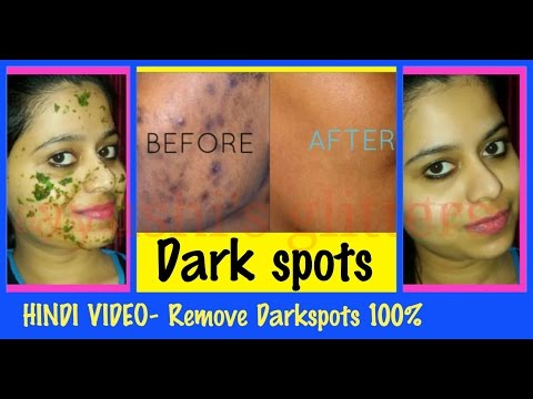 ऐसे-गायब-करे-चेहरे-के-डार्क-स्‍पॉटस-|-remove-dark-spots-and-acne-marks-permanently