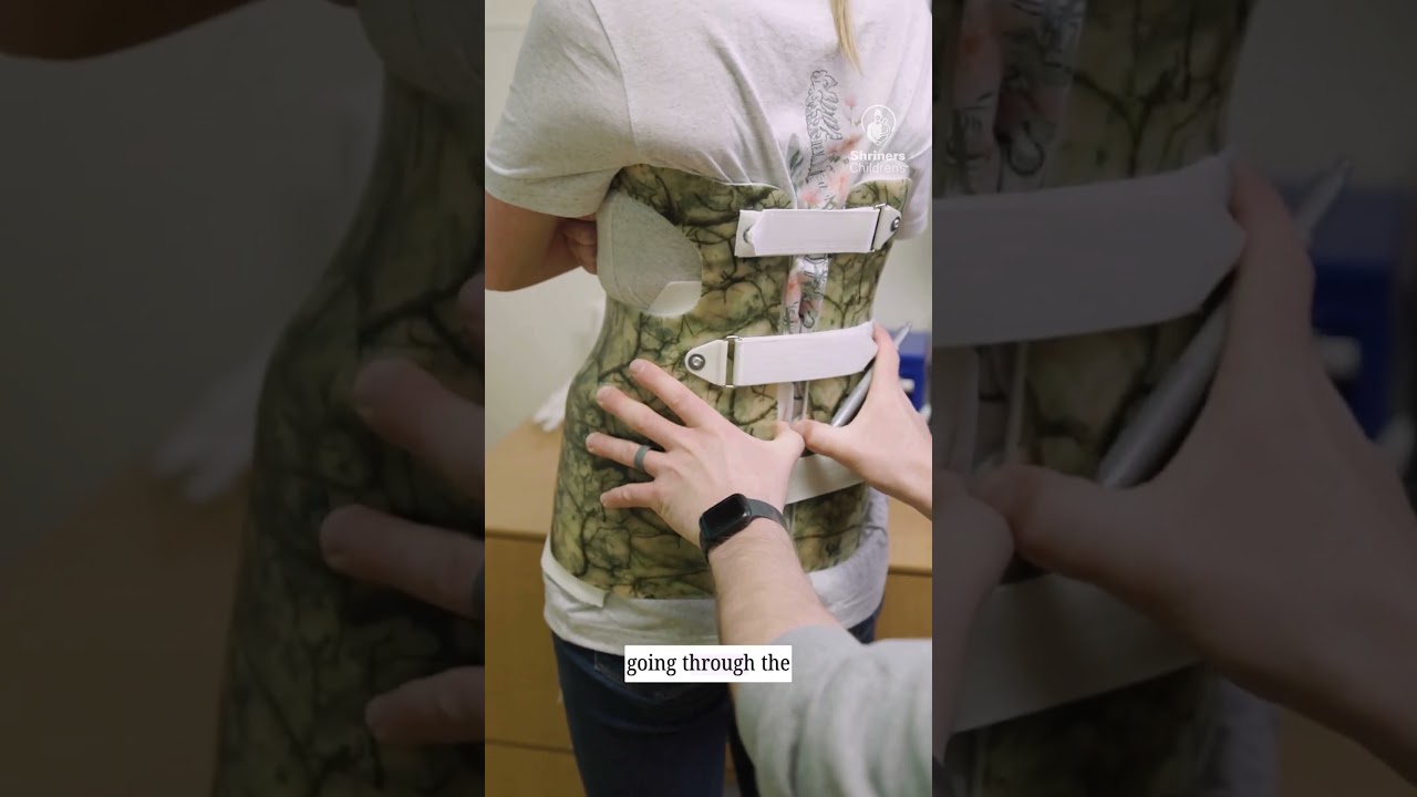 Scoliosis: You Are Not Alone #shrinerschildrens #scoliosis #support