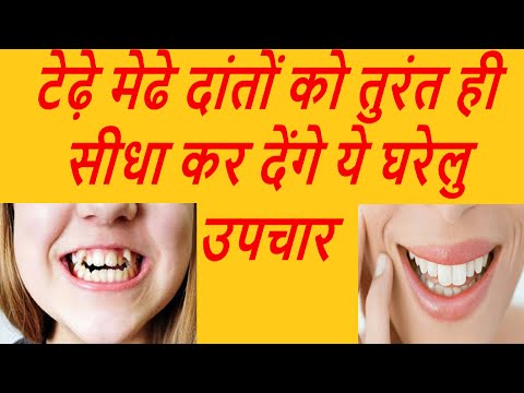वीडियो: क्या लिबास टेढ़े दांतों को ठीक कर सकता है?