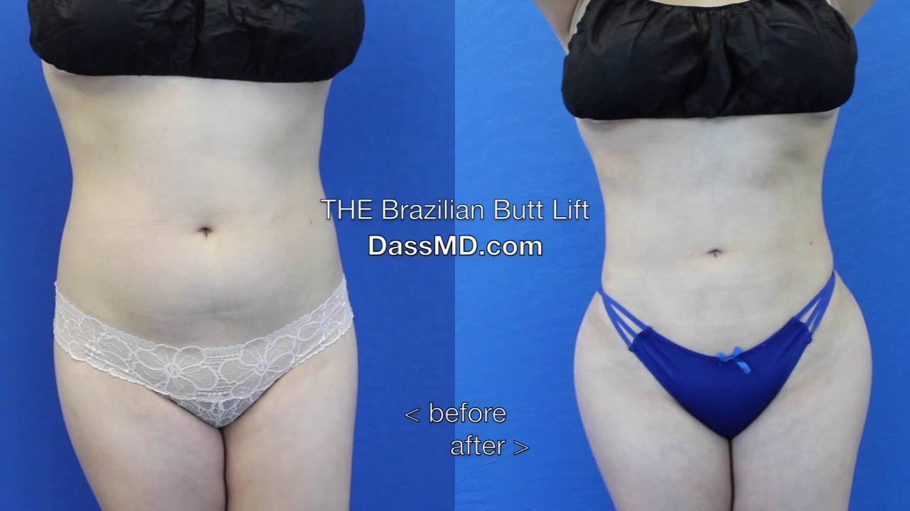 BBL Before After Surgery Recovery Perfect Thighs