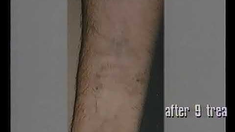 DLR1 QS Ruby Laser - Original Promo Video 1991