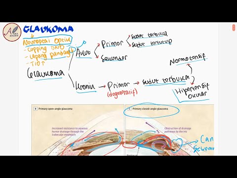 Video: Glaukoma Sudut Terbuka: Vs. Sudut Tertutup, Pengobatan, Gejala, Lebih