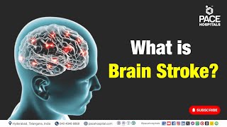 Brain Stroke | What is Brain Stroke? | #brainstroke