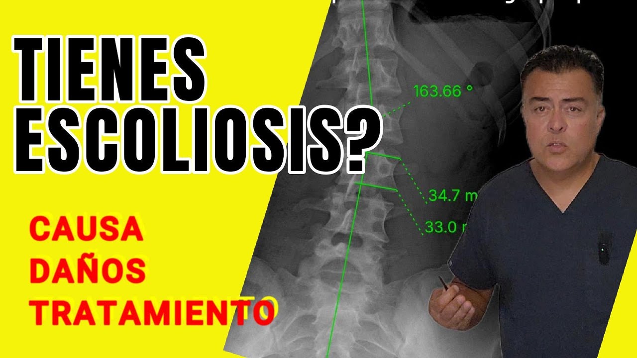 ¡ Qué es  la escoliosis! Aprende cómo tratarla