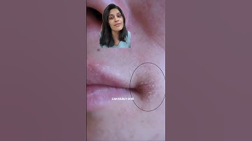 Mouth corner cracks and dryness treatment #skincaretips #dermatologist #hyderabad