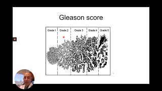 Prostate Cancer Grading and Staging