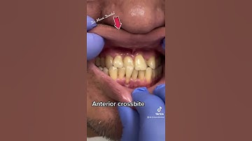 Anterior crossbite !