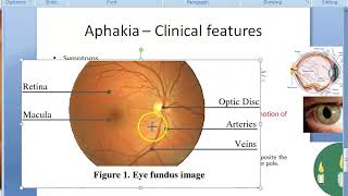 Ophthalmology 047 b Aphakia Clinical features