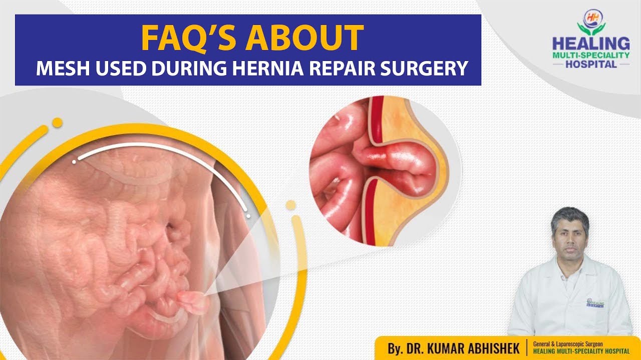 Hernia Repair Using Mesh, General Surgery Clinic Articles
