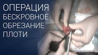 Операция обрезание крайней плоти у мужчин ✅ БЕЗ КРОВИ 18+ Операция обрезание крайней плоти у мужчин ✅ БЕЗ КРОВИ 18+