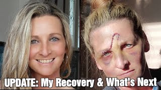 UPDATE: My Recovery & How I Am Doing| New Symptoms| What's Next