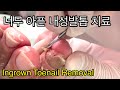 10년 묵은 체증이 내려가는 내성발톱 1,2 차 치료, 덤으로 고랑이 청소 Ingrown toenail removal