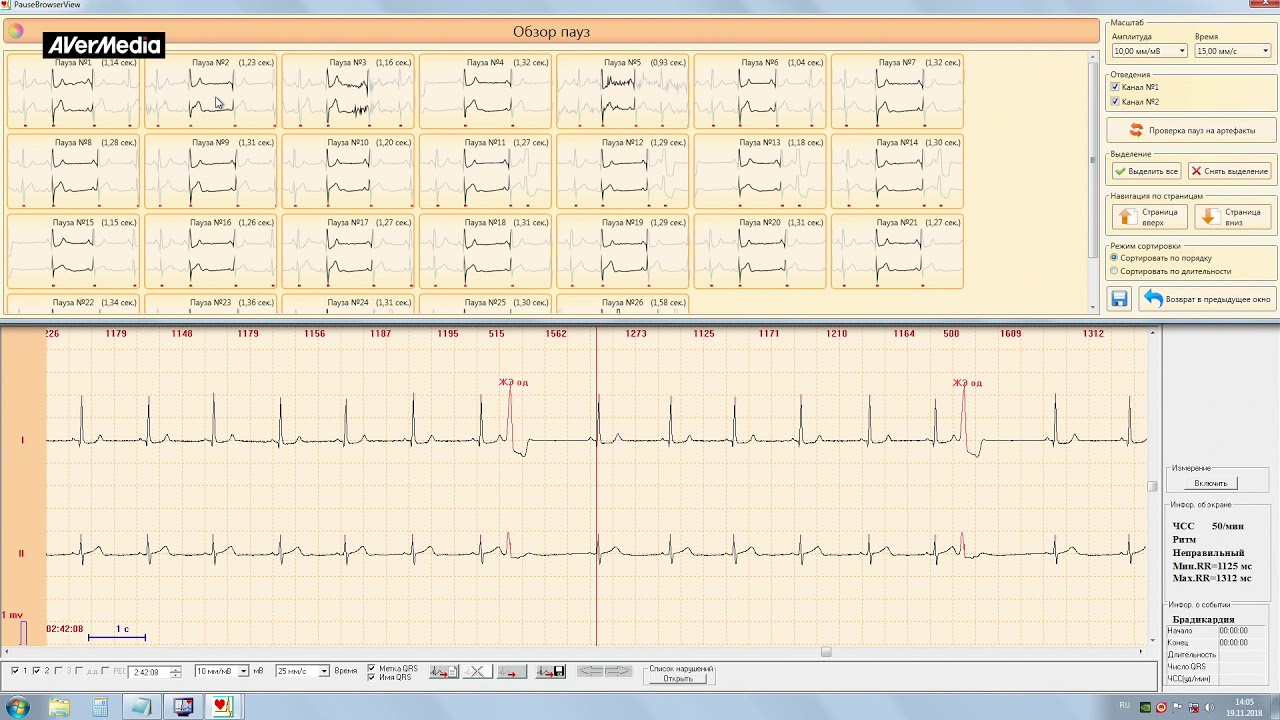 Обзор пауз Видео №7 Холтер "КАРДИО-Астел" - YouTube