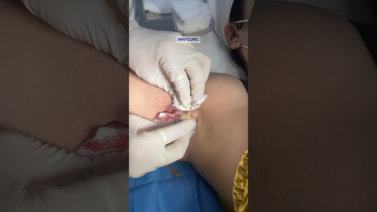 Mụn nhọt ở nách tưởng nhỏ ai ngờ mủ tràn ra từng lớp.