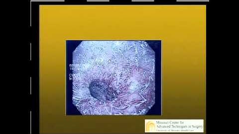 Endoscopy for Surgeons PG: Endoscopic Treatment of Complications After GI Surgery