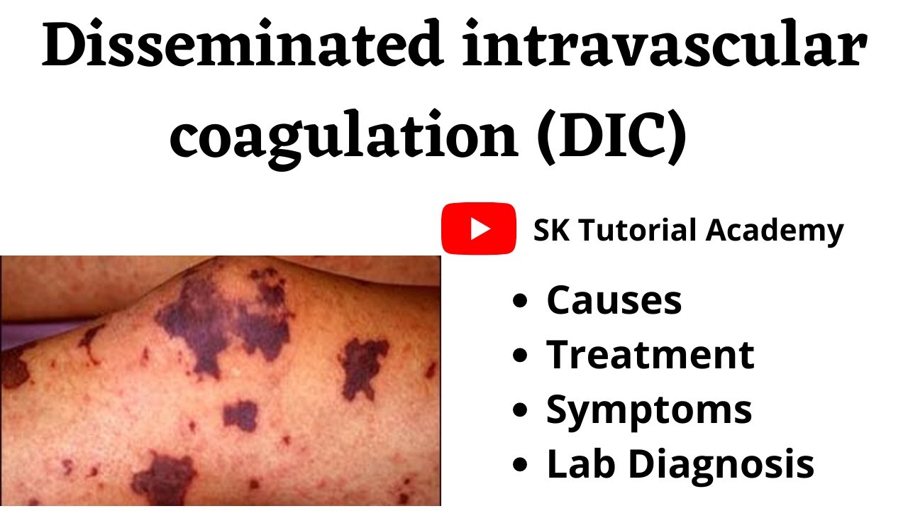 Disseminated Intravascular Coagulation Dic Syndrome Youtube