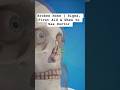 Broken Nose | Signs, First Aid & When to See Doctor