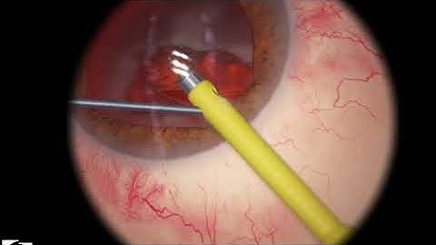 EyeSi CAT C Phaco Divide and Conquer, Level 6