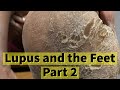 Lupus and the Feet, Part 2: Calluses and Dry Skin
