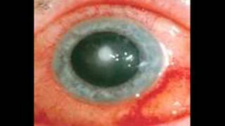 Dangers of Circle Contact Lenses