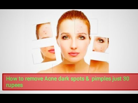 How to Acne dark spots & permanent pimples remove || just  rupees || home easy making full video