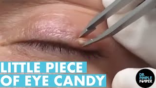 MILIUM Eye Candy 🍬Dr Pimple Popper Satisfies Patient's Request