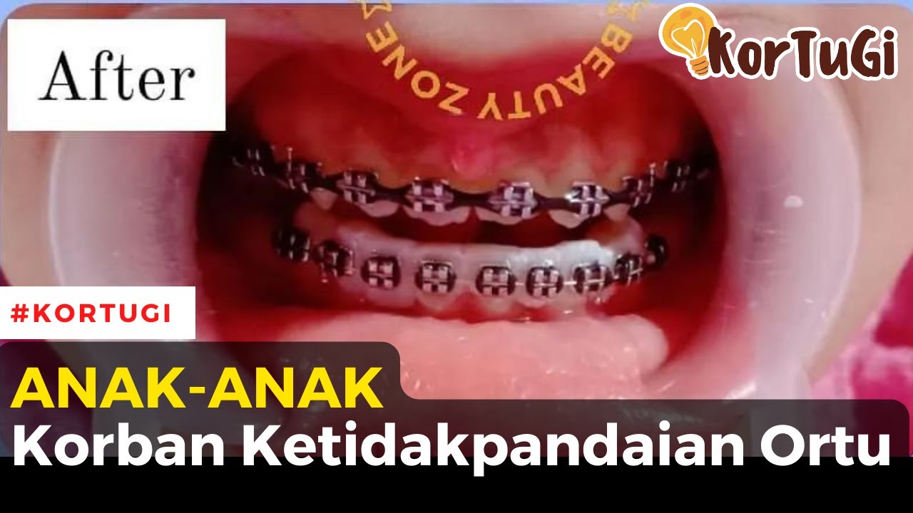 Anak Dibehelin: Korban Ketidakpandaian Ortu | KorTuGi