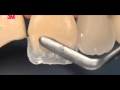 WEB VIDEOS 3M - Esquemas para restauração de dentes anteriores: como usar as diferentes opacidades.