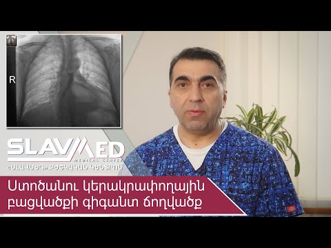 Video: Ո՞ր քառորդում է գտնվում ստամոքսը: