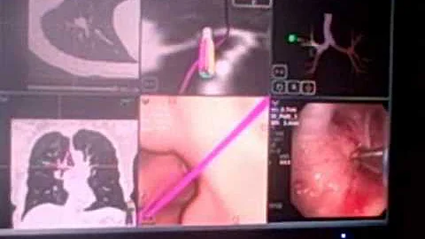 Lung Nodule Diagnosis using Electromagnetic Navigational Bronchoscopy ENB